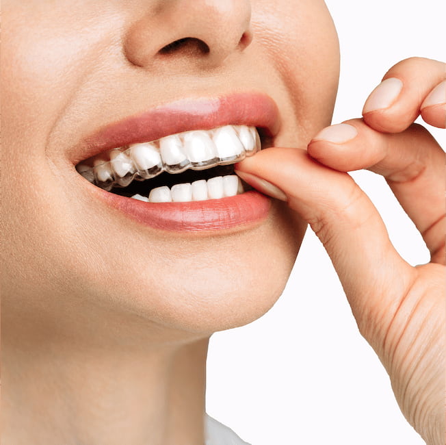 Estética discreta do Invisalign - Aiko Odontoclinic