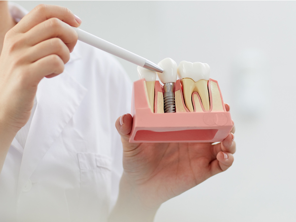 Implantes dentários da Aiko Odontoclinic