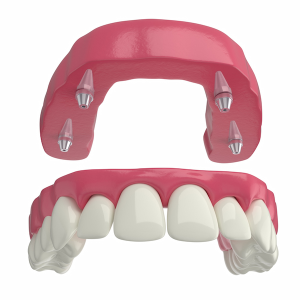 Implante com prótese overdenture - Aiko Odontoclinic