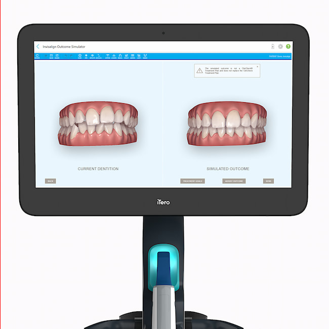Previsibilidade do Invisalign - Aiko Odontoclinic