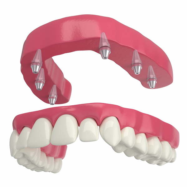 Implante com prótese protocolo - Aiko Odontoclinic