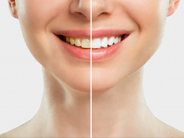 Clareamento dental da Aiko Odontoclinic